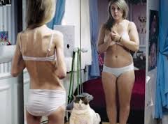Picture_of_Person_with_a_Eating_Disorder